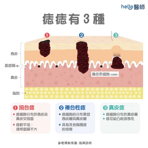 凸痣長毛|為什麼臉上的痣越來越多？皮膚科醫師解析長痣原因、。